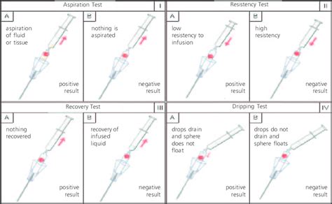 saline drop test definition|what is a veress needle.